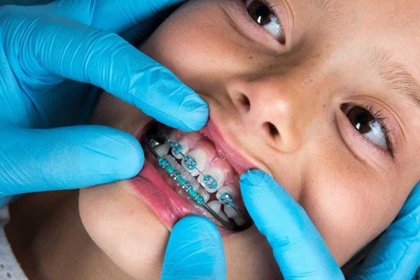 Хэдэн насанд шүдний гажиг заслын аппарат зүүхэд хамгийн тохиромжтой вэ?