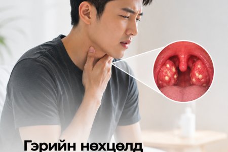 Гэрийн нөхцөлд тонзилын чулууг хэрхэн арилгах вэ?