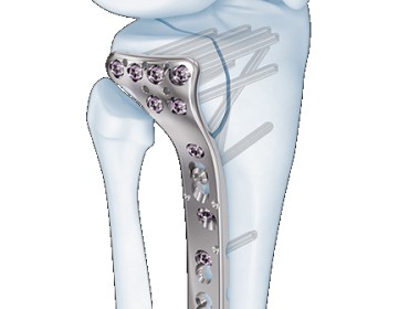 3.5mm VA LCP® Proximal Tibia Plate