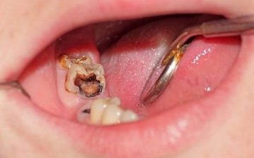 Манай улсад 10 хүүхэд тутмын 9 нь шүдний цооролттой, амны хөндийн өвчлөлтэй байна