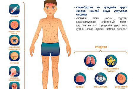 Ханиад уу? Улаанбурхан уу? Яаж ялгах вэ?