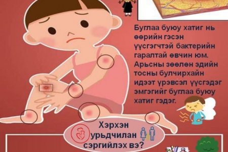 Хатиг буглаа өвчнөөс сэргийлцгээе