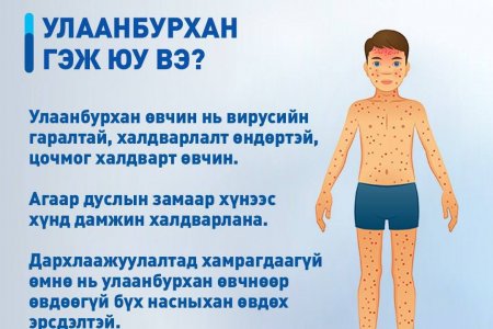  УЛААНБУРХАН ӨВЧНӨӨС ХАМТДАА СЭРГИЙЛЬЕ.