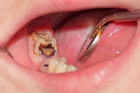 Манай улсад 10 хүүхэд тутмын 9 нь шүдний цооролттой, амны хөндийн өвчлөлтэй байна