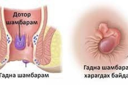 Иргэн таны эрүүл мэндийн мэдлэгт - 1, Шамбарам гэж юу вэ? Шамбарам өвчний шалтгаан, нөлөөлөх хүчин зүйл