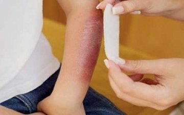 Түлэгдсэн хүүхдүүдэд шаардлагатай эмчилгээ хийх, нөхөн сэргээх физик эмчилгээний тасаг Монгол улсад байхгүй