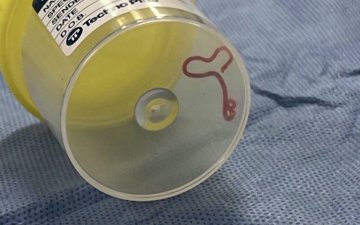 Австрали улсад нэгэн эмэгтэйн тархинаас 8 см урт амьд шимэгч хорхой олджээ