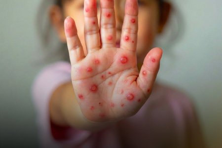 Гар хөл амны өвчин гэж юу вэ? 