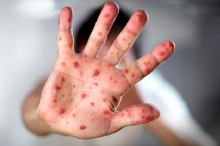 Улаанбурхан өвчний 9 тохиолдол бүртгэгдлээ