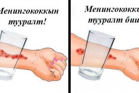Менингококкын халдварын шинж тэмдгийг хэрхэн таних вэ