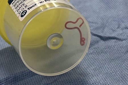 Австрали улсад нэгэн эмэгтэйн тархинаас 8 см урт амьд шимэгч хорхой олджээ
