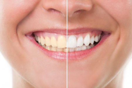Шүд яагаад шарладаг вэ? 