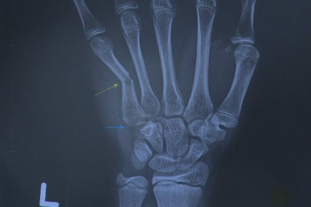 ГССҮТ-д 11 сарын  байдлаар сээр цохисон гэх өгүүлэмжтэй 10 гаруй өвчтөнд хагалгаа хийсэн байна