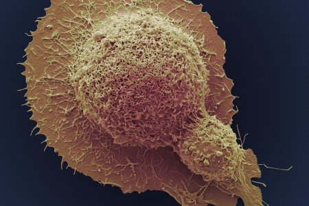 АНУ-д хорт хавдрын улмаас нас барж буй иргэдийн тоо жил бүр тогтмол буурч, эдгэрч буй иргэдийн тоо нэмэгджээ