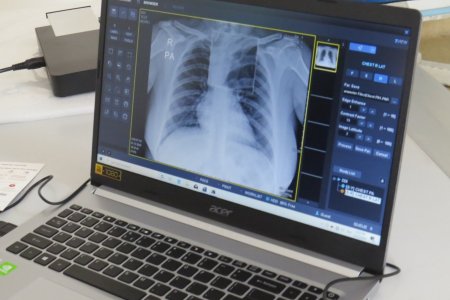 Орчин үеийн зөөврийн дижитал рентген аппарат хүлээн авлаа.