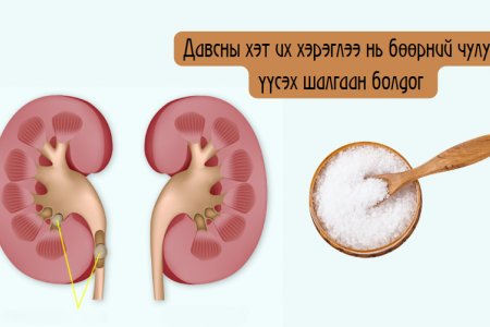 Бөөрний чулуу яагаад үүсдэг вэ?