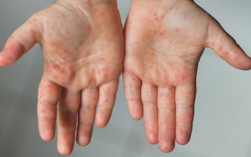 Улаанбурхан өвчний дэгдэлт 350 дах өдрөө үргэлжилж, 25 тохиолдол шинээр бүртгэгджээ