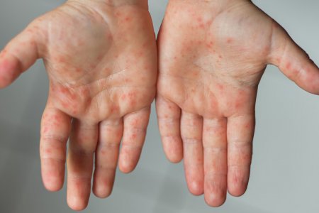 Улаанбурхан өвчний дэгдэлт 350 дах өдрөө үргэлжилж, 25 тохиолдол шинээр бүртгэгджээ