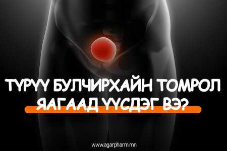 Түрүү булчирхайн томрол үүсэх шалтгаан