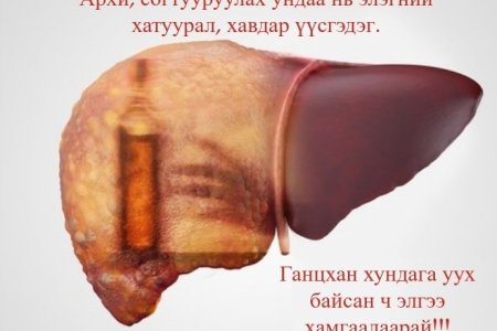 Архи, согтууруулах ундаа хорт хавдар үүсэх шалтгаан болох уу?