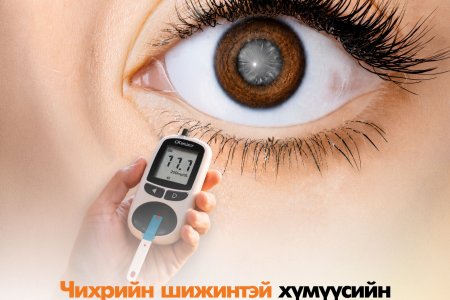 Цусан дахь сахарын хэмжээ удаан хугацаанд өндөр байвал болор цайх эмгэг үүсэх эрсдэлтэй
