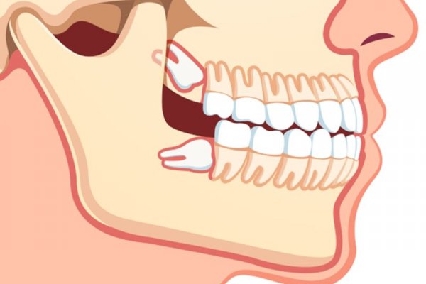 Шүд, эрүү, нүүр амны гажиг үүсэх шалтгаан