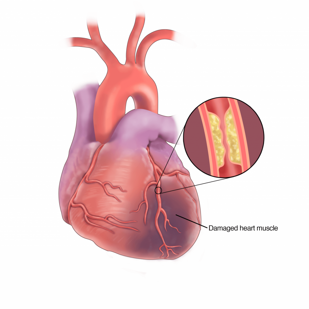 Зүрх судасны эмгэгийн энгийн багц