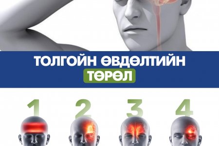 Толгойн өвдөлтийн төрлүүдийн ялгаа