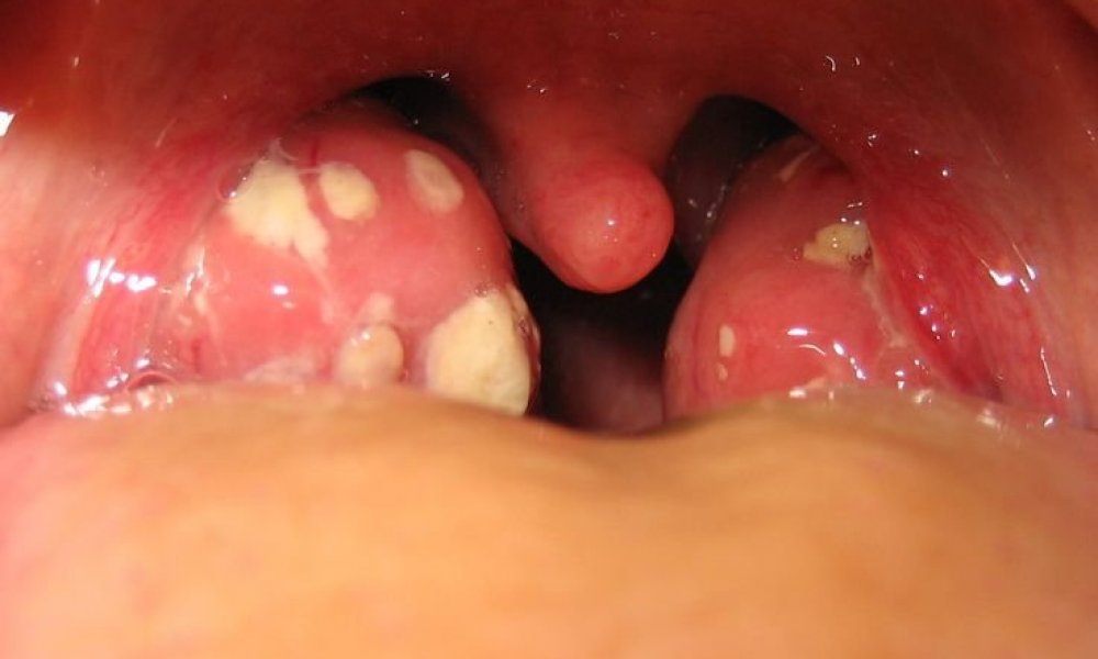 Хоолой махаа авахуулсны дараах  14 хоногийн дэглэм