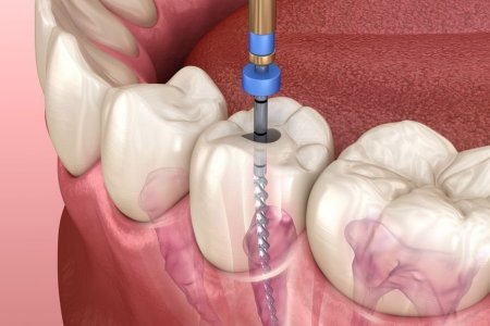 Шүдний мэдрэл тасдах сувгийн эмчилгээ гэж юу вэ?