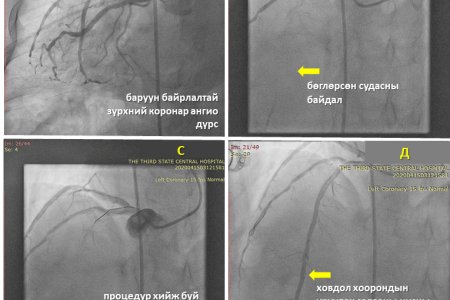 УЛСЫН ГУРАВДУГААР ТӨВ ЭМНЭЛЭГ МОНГОЛ УЛСАД АНХ УДАА ТӨРӨЛХИЙН БАРУУН БАЙРЛАЛТАЙ ЗҮРХТЭЙ ХҮНД ТИТЭМ СУДСАН ДОТУУР ТЭЛЭГЧ СТЕНТ СУУЛГАХ ЭМЧИЛГЭЭ ХИЙЛЭЭ