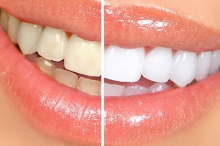 Та шүднийхээ өнгөнд хэр сэтгэл ханамжтай байдаг вэ?  Шүд цайруулах үйлчилгээний тухай