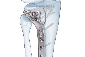 3.5mm VA LCP® Proximal Tibia Plate