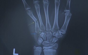 ГССҮТ-д 11 сарын  байдлаар сээр цохисон гэх өгүүлэмжтэй 10 гаруй өвчтөнд хагалгаа хийсэн байна