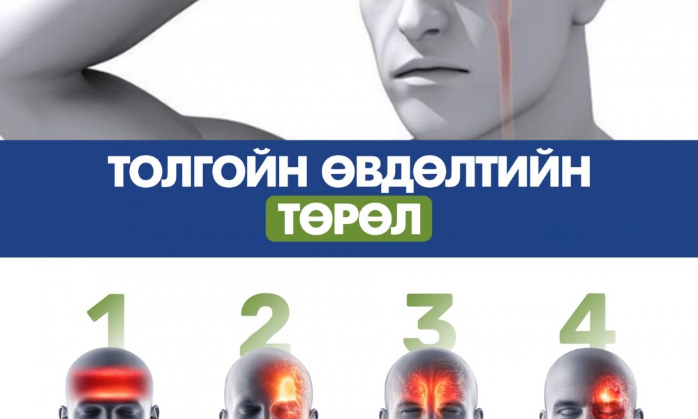 Толгойн өвдөлтийн төрлүүдийн ялгаа