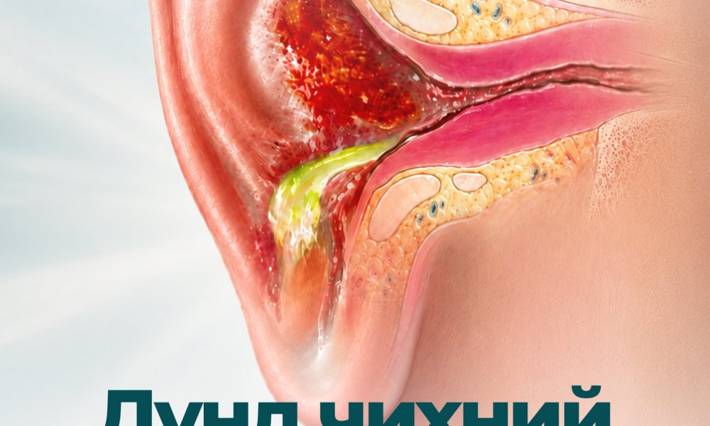 Дунд чихний үрэвсэл: Шинж тэмдэг, шалтгаан, эмчилгээ, урьдчилан сэргийлэлт  