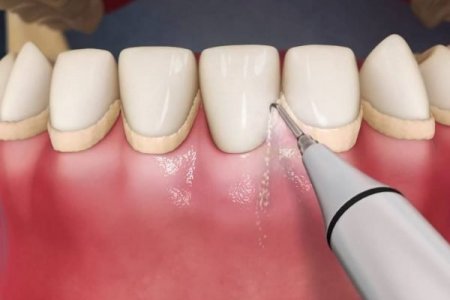 Шүдний чулуу гэж юу вэ?