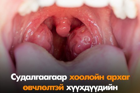 Гүйлсэн булчирхай яагаад томордог вэ?
