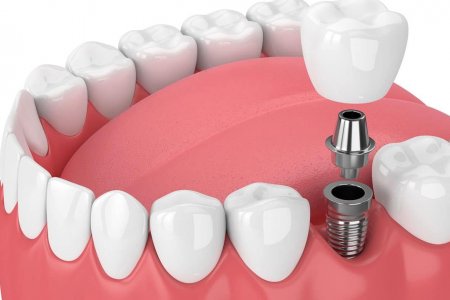 Имплант шүд гэж юу вэ?