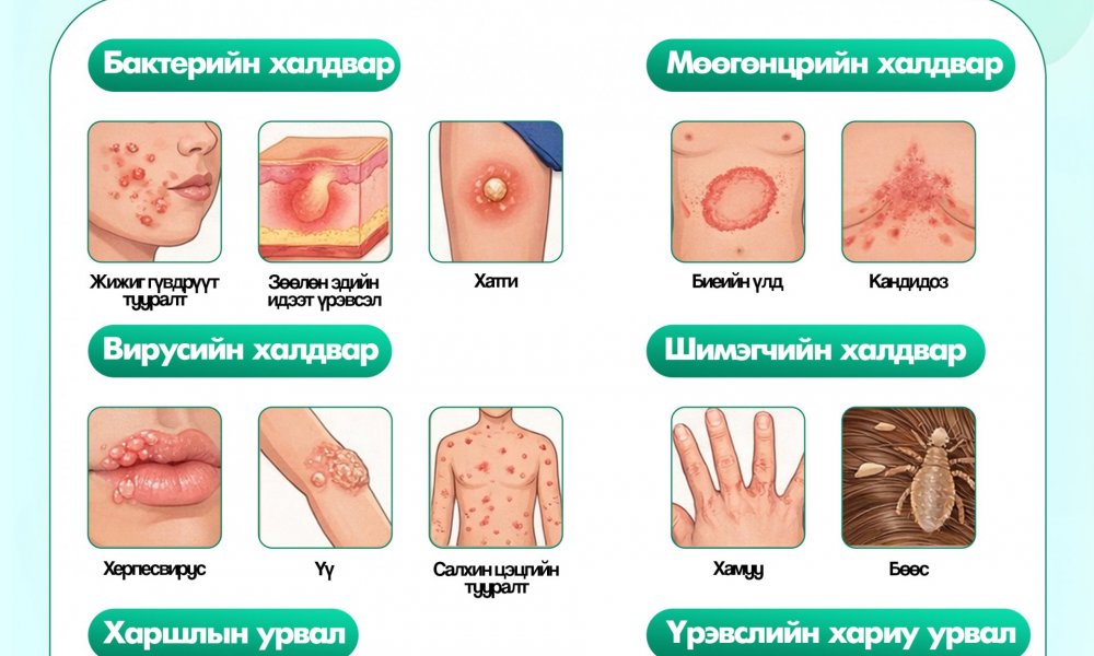 Арьсны үрэвслийн төрлүүд 