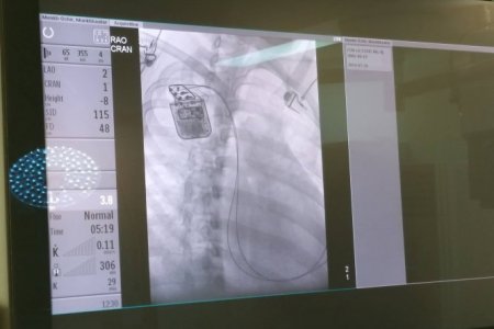 Зүрхний агшилтыг дэмжигч төхөөрөмж буюу Cardiac Contractility Modulation