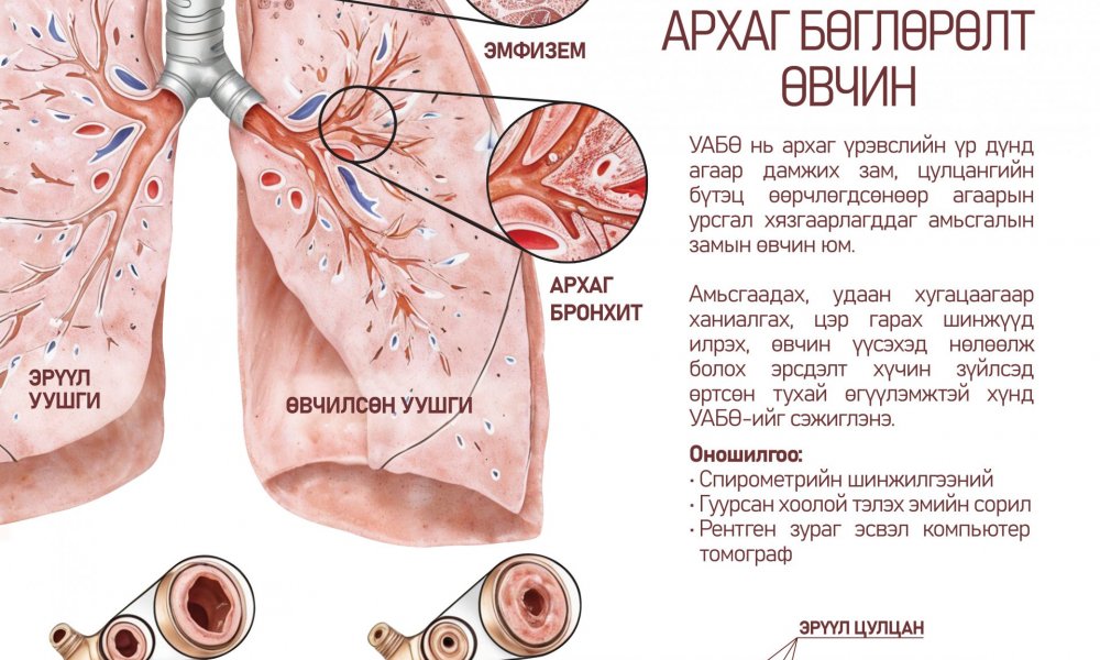 Шатаар өгсөхөд амьсгал давчдах, амьсгаадах нь уушгины архаг бөглөрөлт өвчний шинж