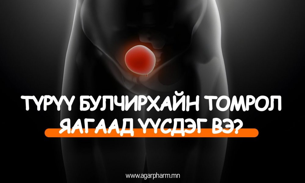 Түрүү булчирхайн томрол үүсэх шалтгаан