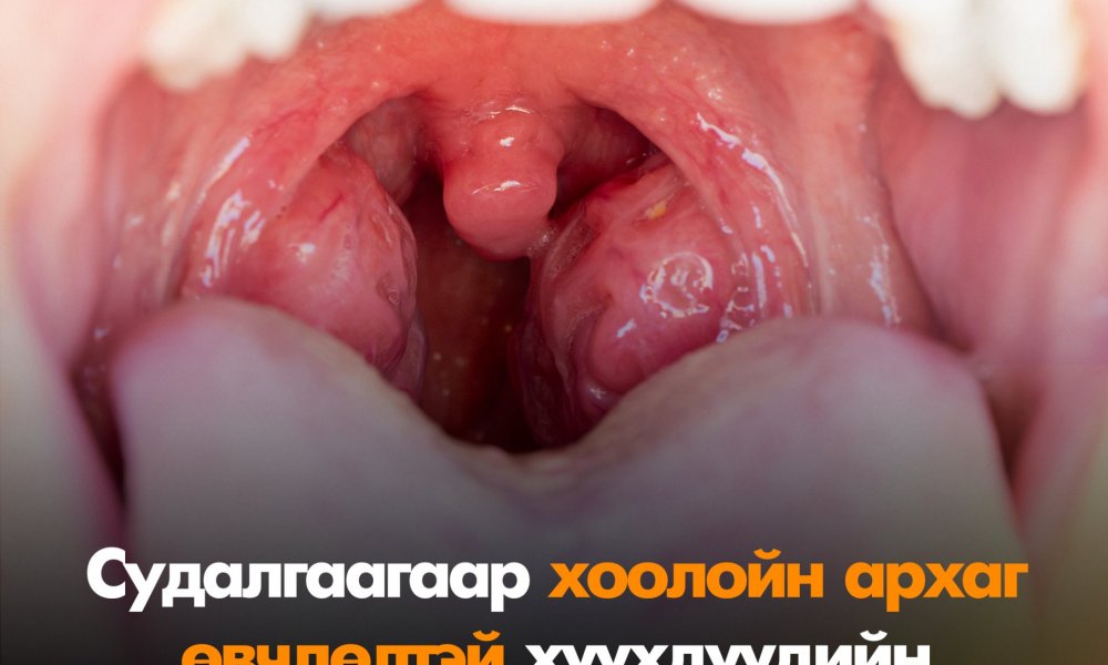 Гүйлсэн булчирхай яагаад томордог вэ?
