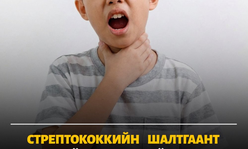 Гүйлсэн булчирхайн үрэвсэл буюу хоолойн өвдөлтийг тоохгүй өнгөрөөж болохгүй