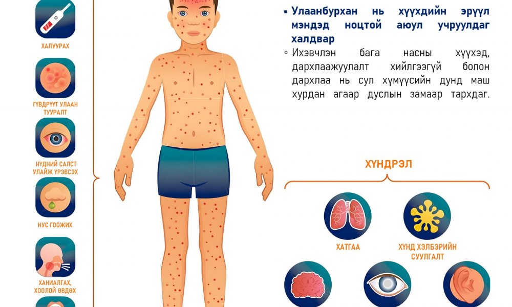 Ханиад уу? Улаанбурхан уу? Яаж ялгах вэ?