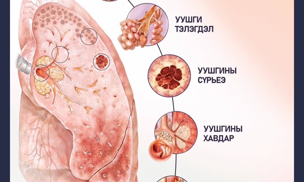Таны уушгинд тусламж хэрэгтэй байгааг илтгэх 5 шинж 