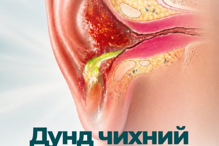 Дунд чихний үрэвсэл: Шинж тэмдэг, шалтгаан, эмчилгээ, урьдчилан сэргийлэлт