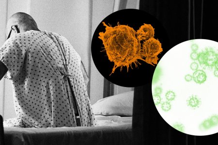 Хорт хавдраар өвчилсөн иргэдийн дийлэнх хувийг эрэгтэйчүүд эзэлж байна