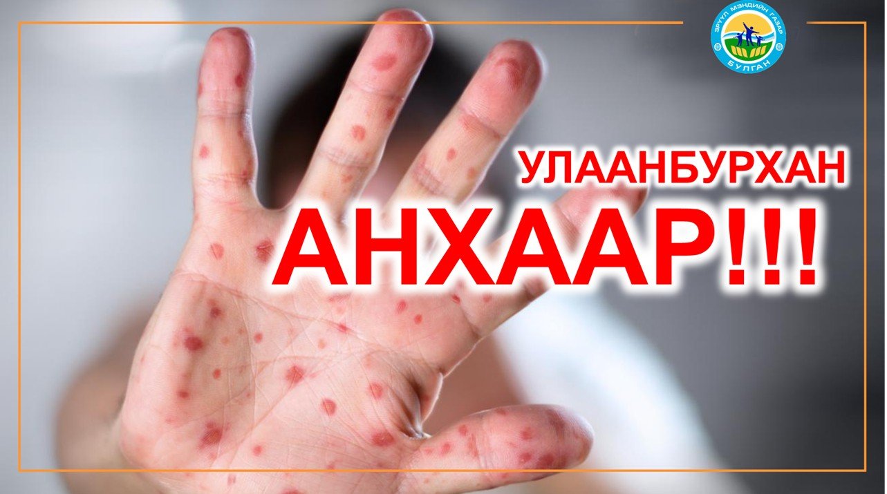 УЛААНБУРХАН ӨВЧНИЙ ТОХИОЛДОЛ БҮРТГЭГДЛЭЭ. 